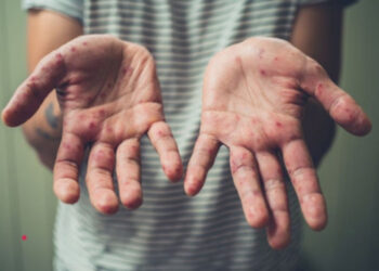 El número de casos de sarampión en México