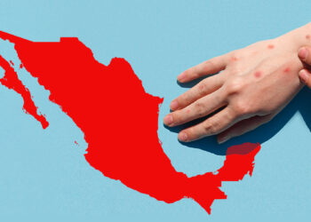 Sarampión en México: aumentan los casos y la preocupación ante la baja cobertura de vacunación